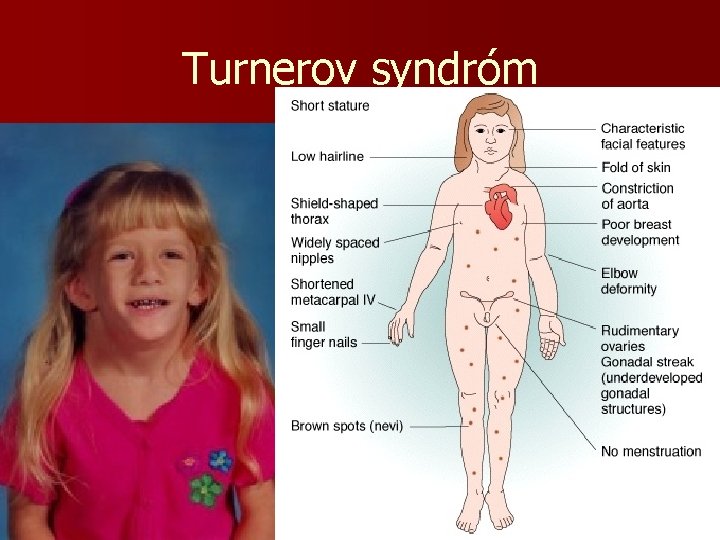 Turnerov syndróm 