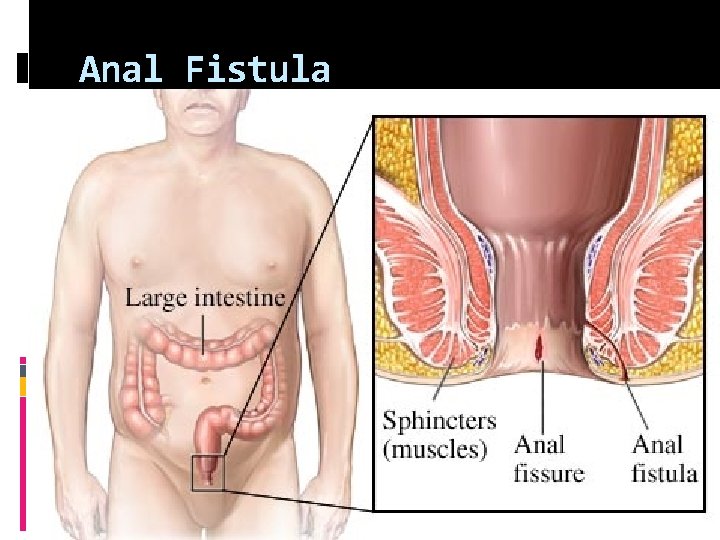 Anal Fistula 