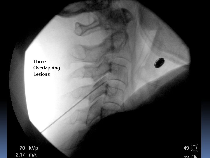 Three Overlapping Lesions 