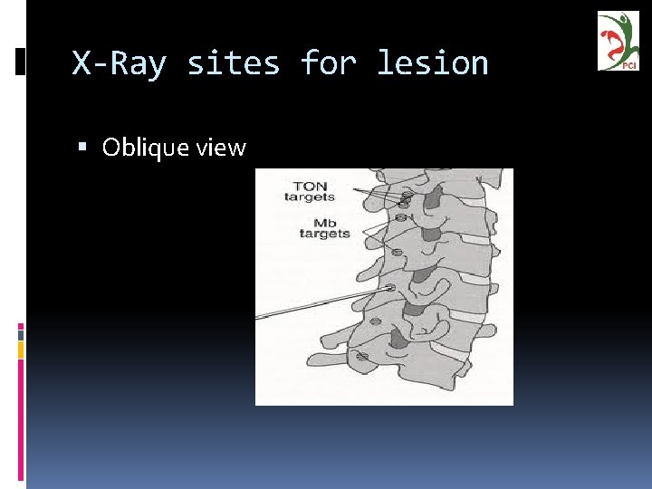 X-Ray sites for lesion Oblique view 