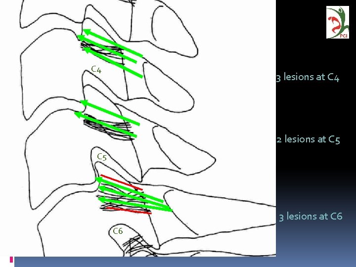 C 4 3 lesions at C 4 2 lesions at C 5 3 lesions