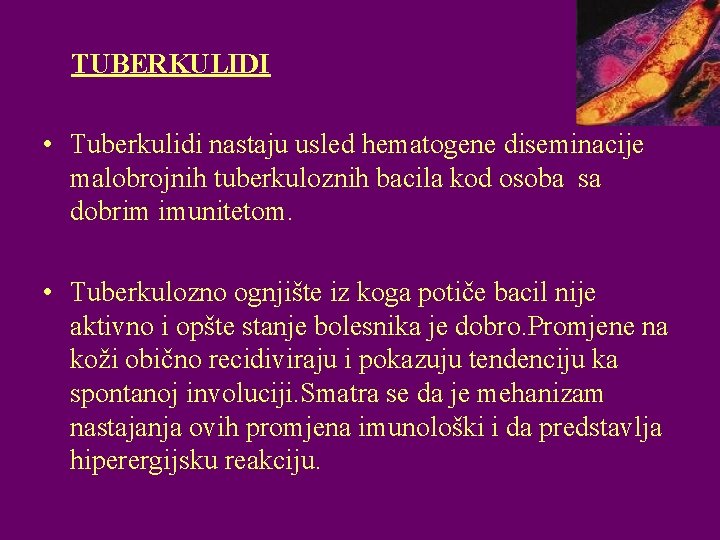 TUBERKULIDI • Tuberkulidi nastaju usled hematogene diseminacije malobrojnih tuberkuloznih bacila kod osoba sa dobrim