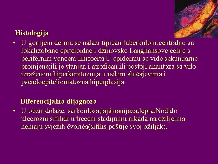 Histologija • U gornjem dermu se nalazi tipičan tuberkulom: centralno su lokalizobane epiteloidne i