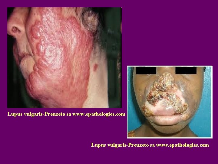 Lupus vulgaris-Preuzeto sa www. epathologies. com 