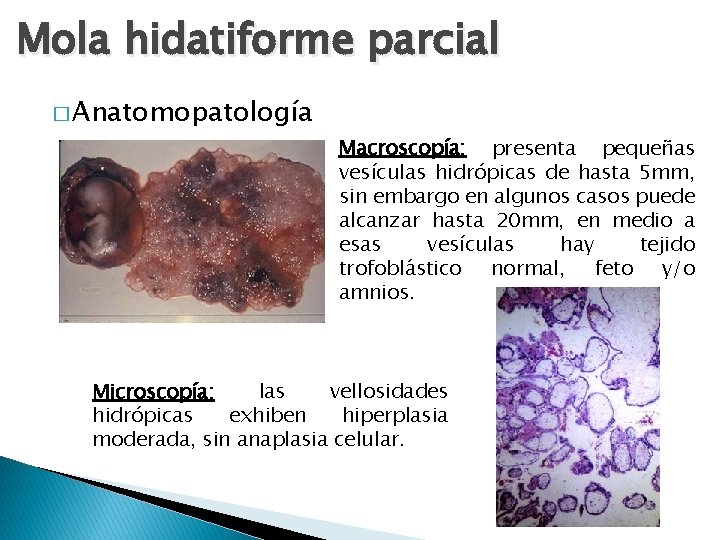 Mola hidatiforme parcial � Anatomopatología Macroscopía: presenta pequeñas vesículas hidrópicas de hasta 5 mm,