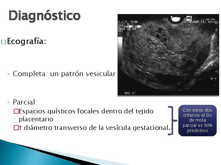 Diagnóstico � Ecografía: ◦ Completa: un patrón vesicular ◦ Parcial: �Espacios quísticos focales dentro