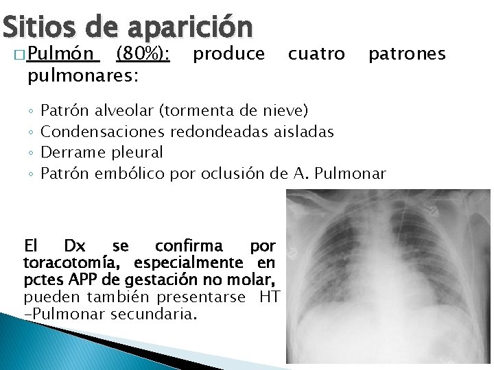 Sitios de aparición � Pulmón (80%): pulmonares: ◦ ◦ produce cuatro patrones Patrón alveolar