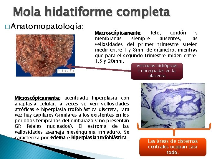 Mola hidatiforme completa � Anatomopatología: Macroscópicamente: feto, cordón y membranas siempre ausentes, las vellosidades