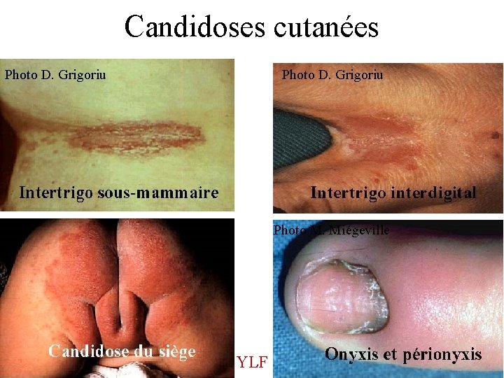 Candidoses cutanées Photo D. Grigoriu Photo M. Miégeville YLF 