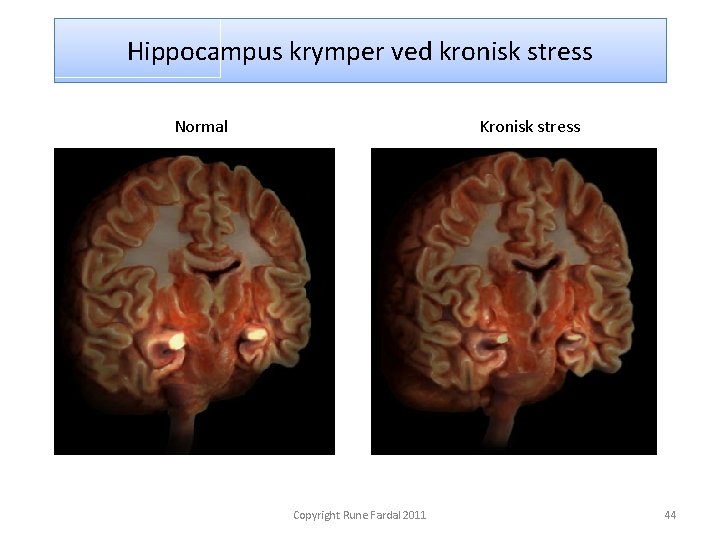 Hippocampus krymper ved kronisk stress Normal Kronisk stress Copyright Rune Fardal 2011 44 