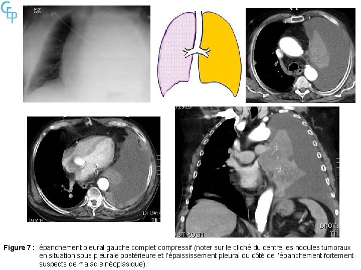 Figure 7 : épanchement pleural gauche complet compressif (noter sur le cliché du centre