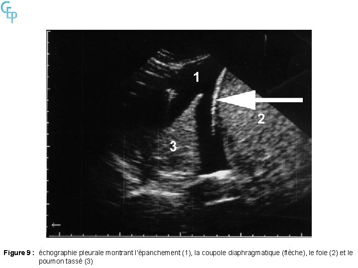 Figure 9 : échographie pleurale montrant l’épanchement (1), la coupole diaphragmatique (flèche), le foie