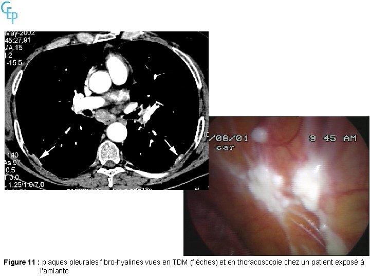 Figure 11 : plaques pleurales fibro-hyalines vues en TDM (flèches) et en thoracoscopie chez