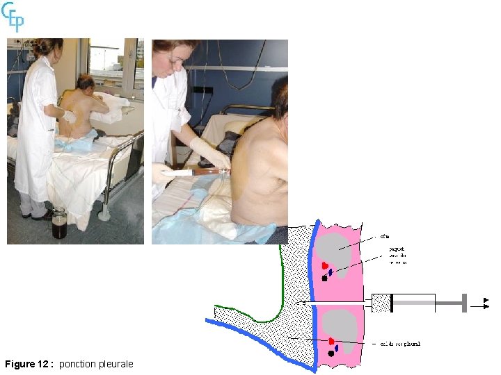 Figure 12 : ponction pleurale 