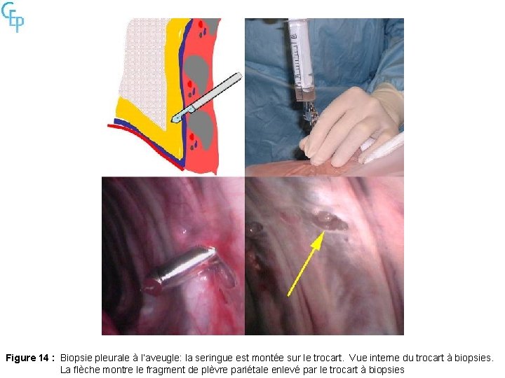 Figure 14 : Biopsie pleurale à l’aveugle: la seringue est montée sur le trocart.