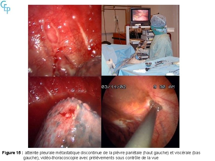 Figure 15 : atteinte pleurale métastatique discontinue de la plèvre pariétale (haut gauche) et