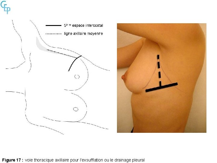 Figure 17 : voie thoracique axillaire pour l’exsufflation ou le drainage pleural 