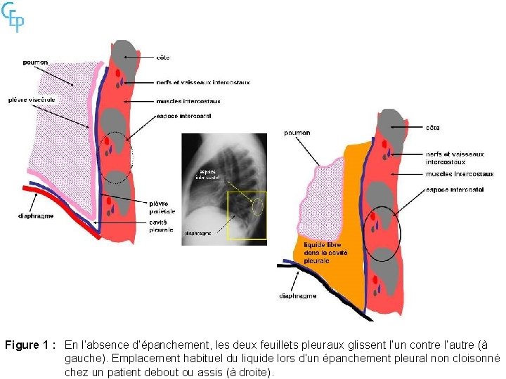 Figure 1 : En l’absence d’épanchement, les deux feuillets pleuraux glissent l’un contre l’autre