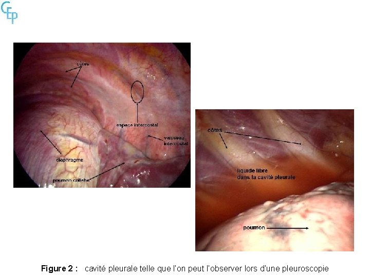 Figure 2 : cavité pleurale telle que l’on peut l’observer lors d’une pleuroscopie 