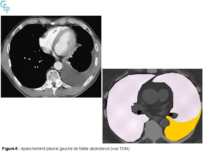 Figure 5 : épanchement pleural gauche de faible abondance (vue TDM) 