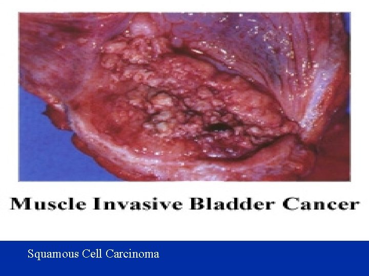  Squamous Cell Carcinoma 