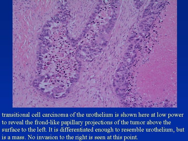 transitional cell carcinoma of the urothelium is shown here at low power to reveal