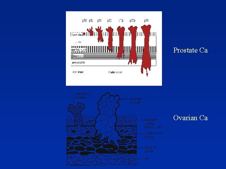 Prostate Ca Ovarian Ca 