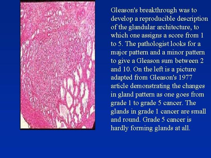 Gleason's breakthrough was to develop a reproducible description of the glandular architecture, to which