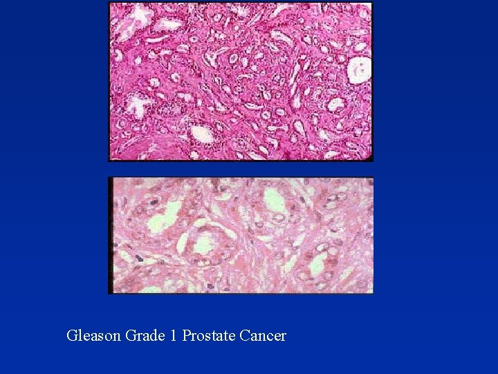  Gleason Grade 1 Prostate Cancer 