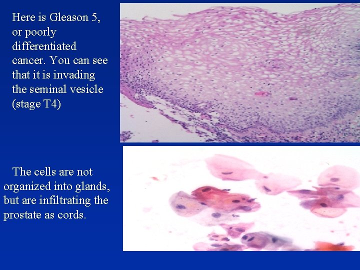 Here is Gleason 5, or poorly differentiated cancer. You can see that it is