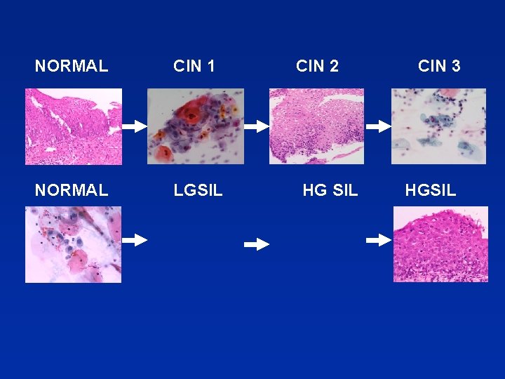 NORMAL CIN 1 NORMAL LGSIL CIN 2 HG SIL CIN 3 HGSIL 