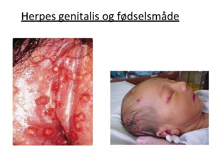 Herpes genitalis og fødselsmåde 