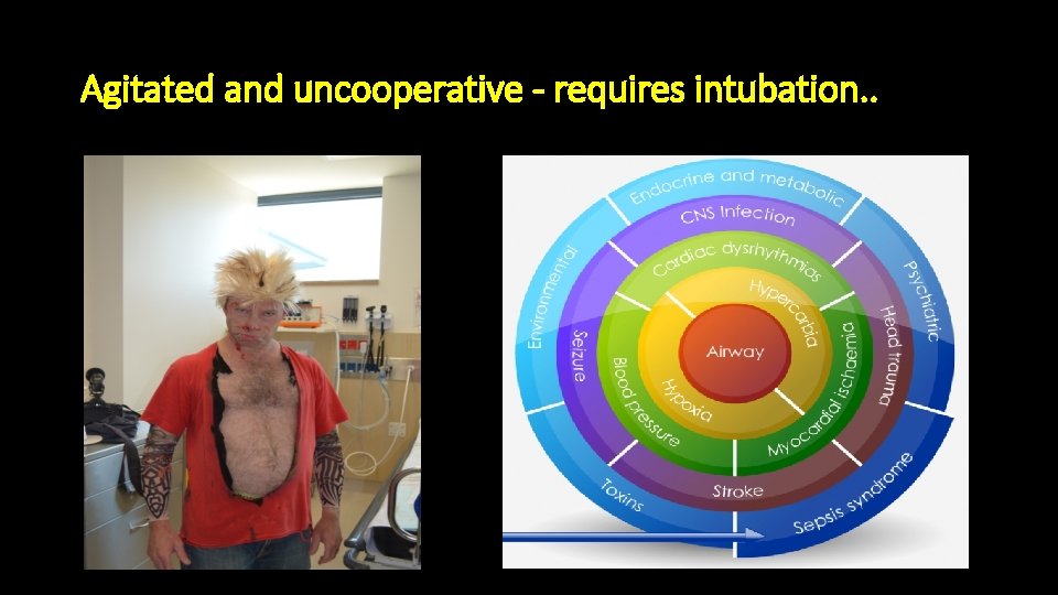 Agitated and uncooperative - requires intubation. . 