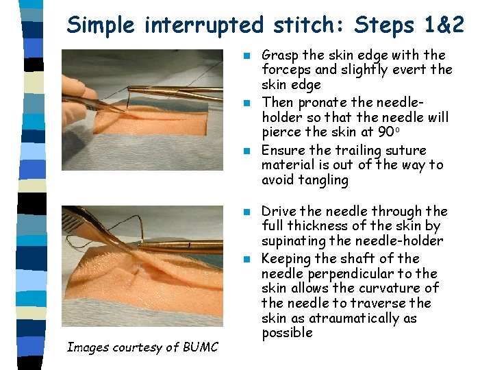 Simple interrupted stitch: Steps 1&2 Grasp the skin edge with the forceps and slightly Simple interrupted stitch: Steps 1&2 Grasp the skin edge with the forceps and slightly