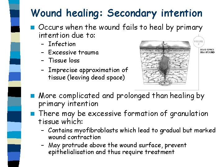 Wound healing: Secondary intention n Occurs when the wound fails to heal by primary Wound healing: Secondary intention n Occurs when the wound fails to heal by primary