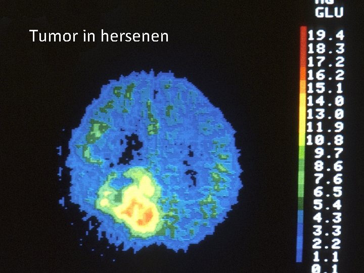 Tumor in hersenen 