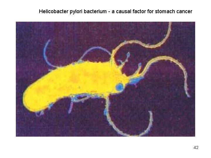 Helicobacter pylori bacterium - a causal factor for stomach cancer 42 