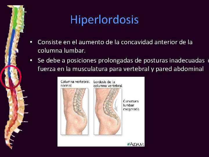 Hiperlordosis • Consiste en el aumento de la concavidad anterior de la columna lumbar.