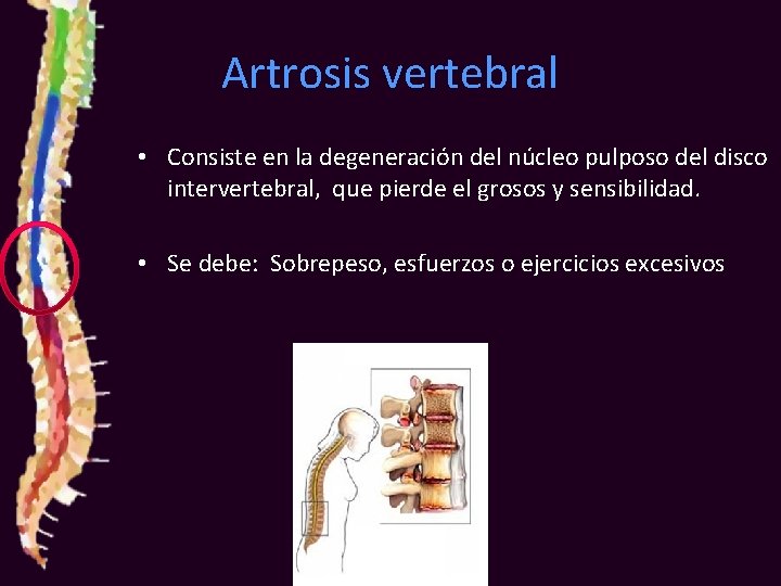Artrosis vertebral • Consiste en la degeneración del núcleo pulposo del disco intervertebral, que