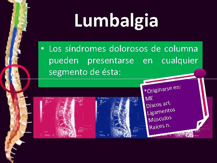 Lumbalgia • Los síndromes dolorosos de columna pueden presentarse en cualquier segmento de ésta: