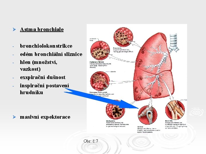 Ø Astma bronchiale - bronchiolokonstrikce edém bronchiální sliznice hlen (množství, vazkost) exspirační dušnost inspirační