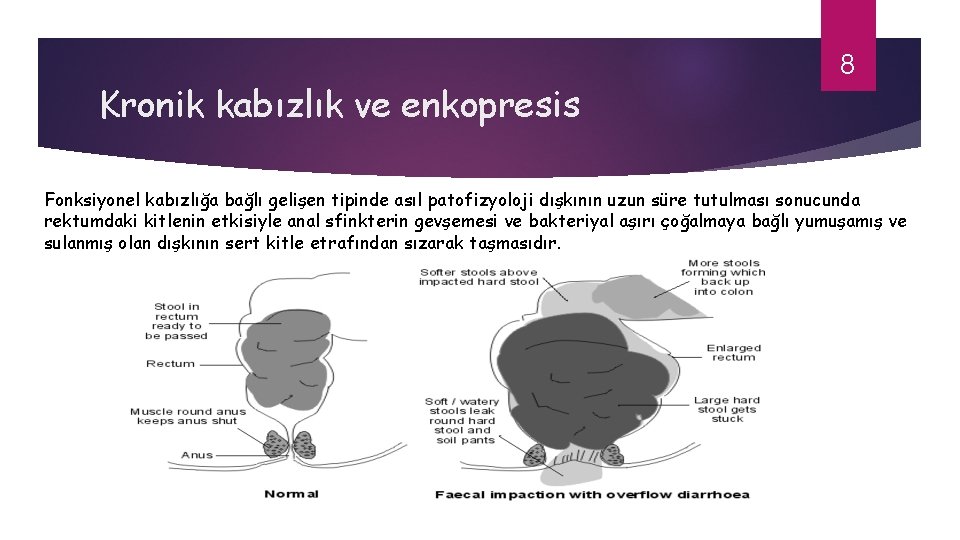 Kronik kabızlık ve enkopresis 8 Fonksiyonel kabızlığa bağlı gelişen tipinde asıl patofizyoloji dışkının uzun