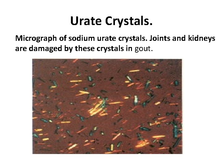 Urate Crystals. Micrograph of sodium urate crystals. Joints and kidneys are damaged by these