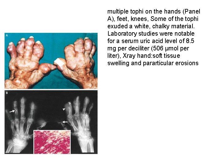 multiple tophi on the hands (Panel A), feet, knees, Some of the tophi exuded