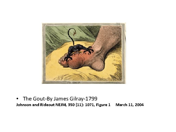  • The Gout-By James Gilray-1799 Johnson and Rideout NEJM, 350 (11): 1071, Figure
