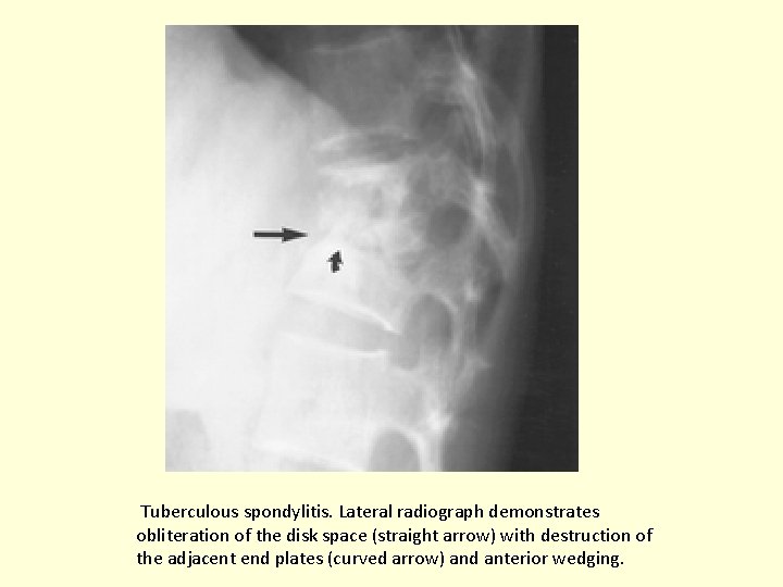  Tuberculous spondylitis. Lateral radiograph demonstrates obliteration of the disk space (straight arrow) with