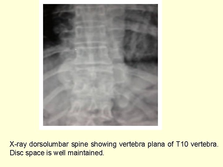 X-ray dorsolumbar spine showing vertebra plana of T 10 vertebra. Disc space is well