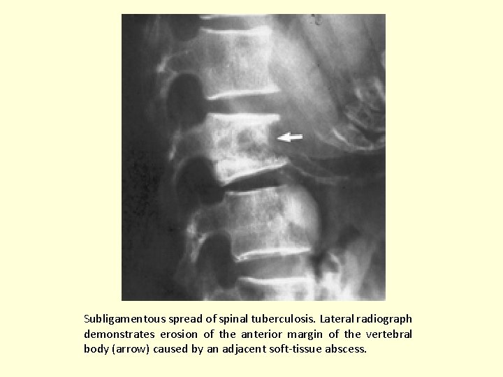 Subligamentous spread of spinal tuberculosis. Lateral radiograph demonstrates erosion of the anterior margin of