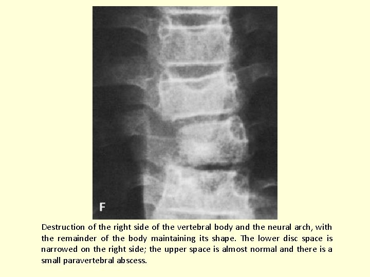 Destruction of the right side of the vertebral body and the neural arch, with