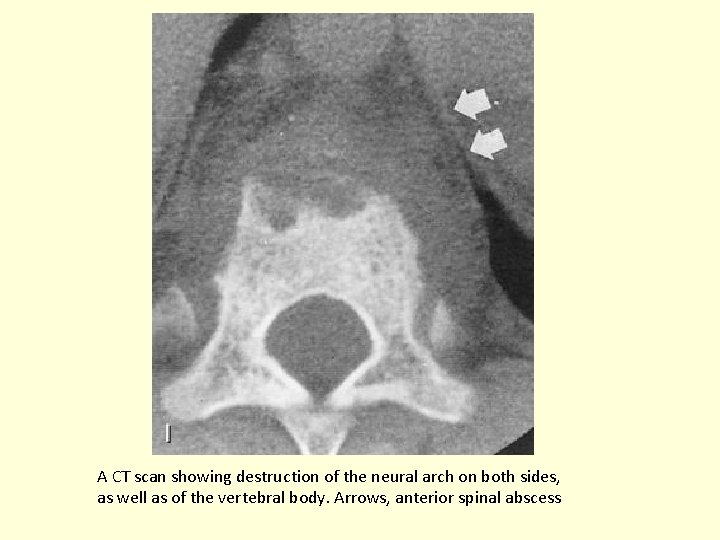 A CT scan showing destruction of the neural arch on both sides, as well